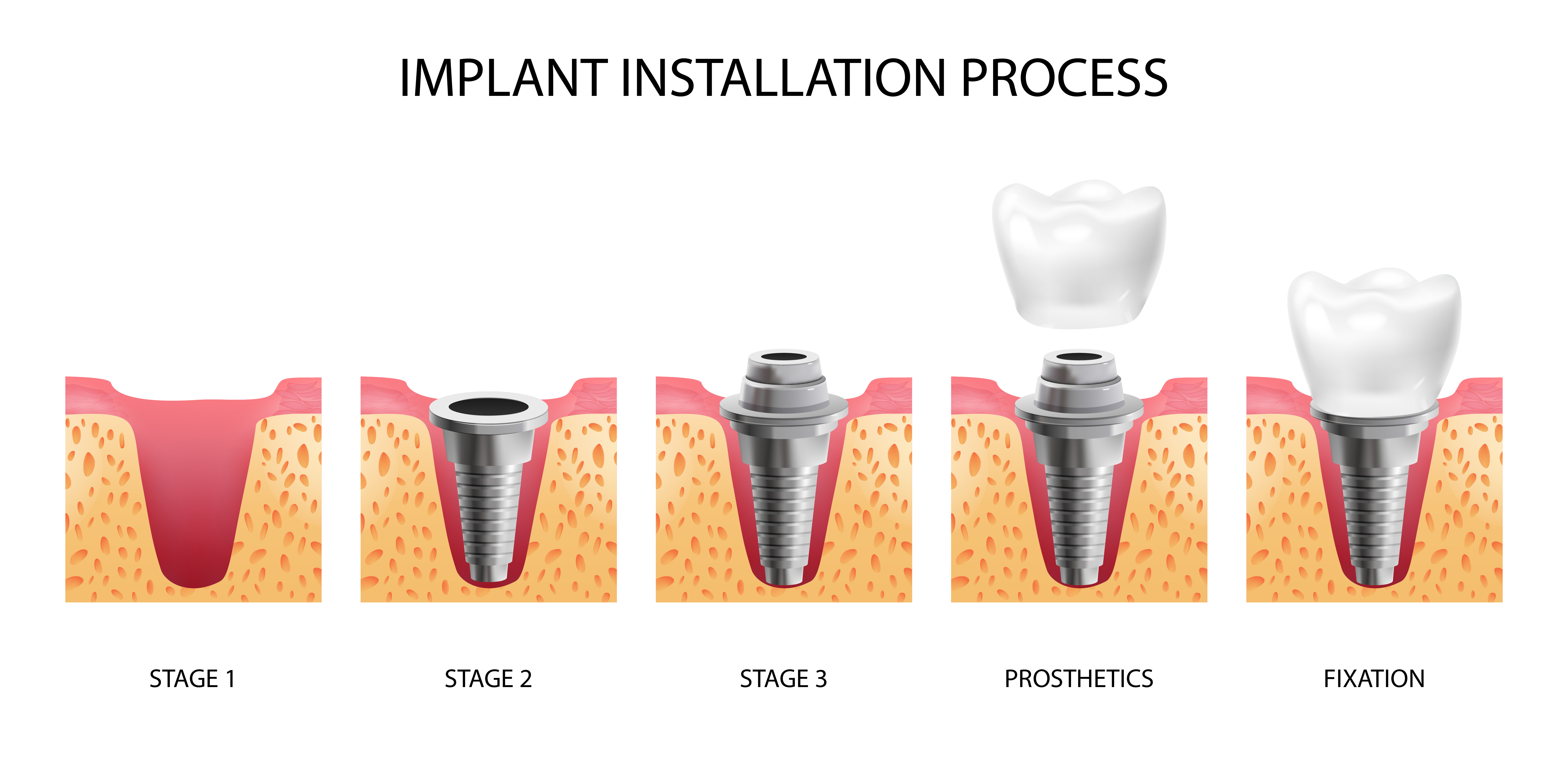 LATEST AND ADVANCED TREND OF DENTAL IMPLANTOLOGY
