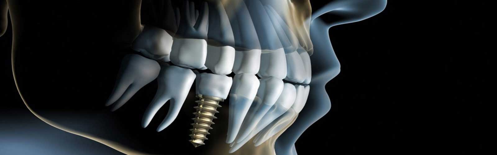 LATEST AND ADVANCED TREND OF DENTAL IMPLANTOLOGY