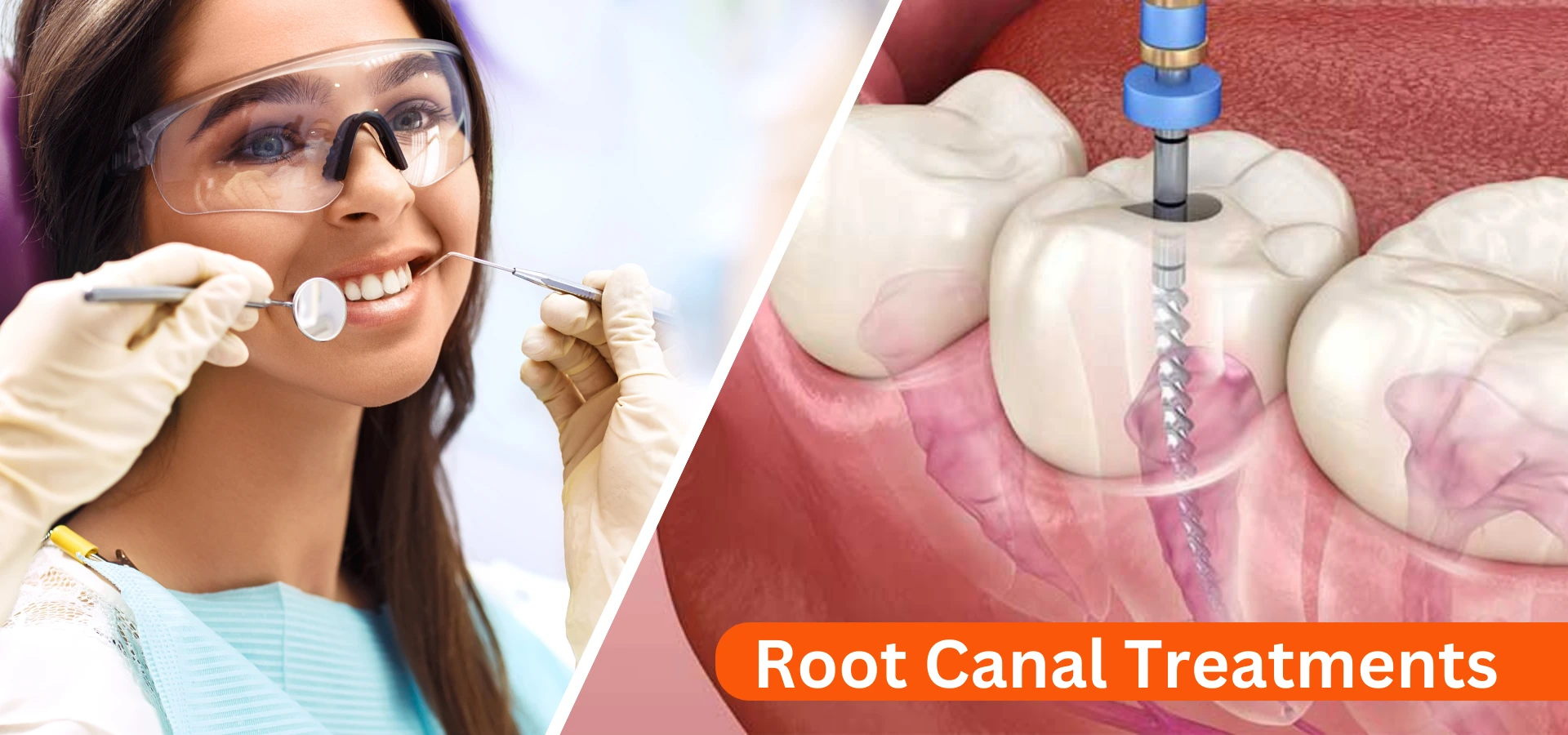 root canal in gurgaon