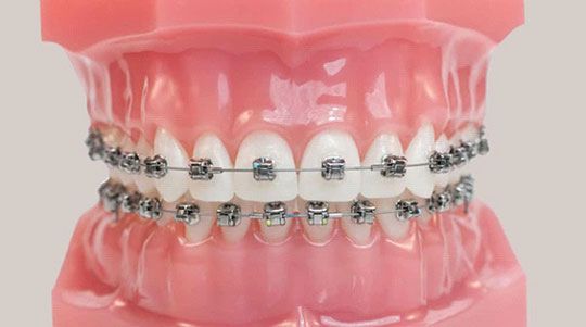 dental braces cost