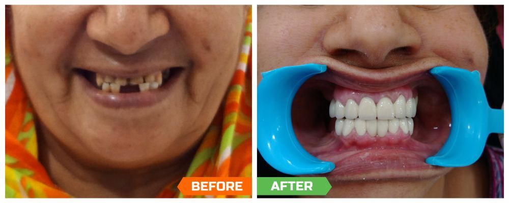 Top dental implant surgeons in India