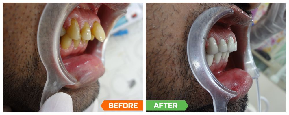Best dental implant surgeons in India