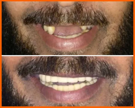 كم تكلفة زراعة الأسنان في سلطنة المملكة العربية السعودية