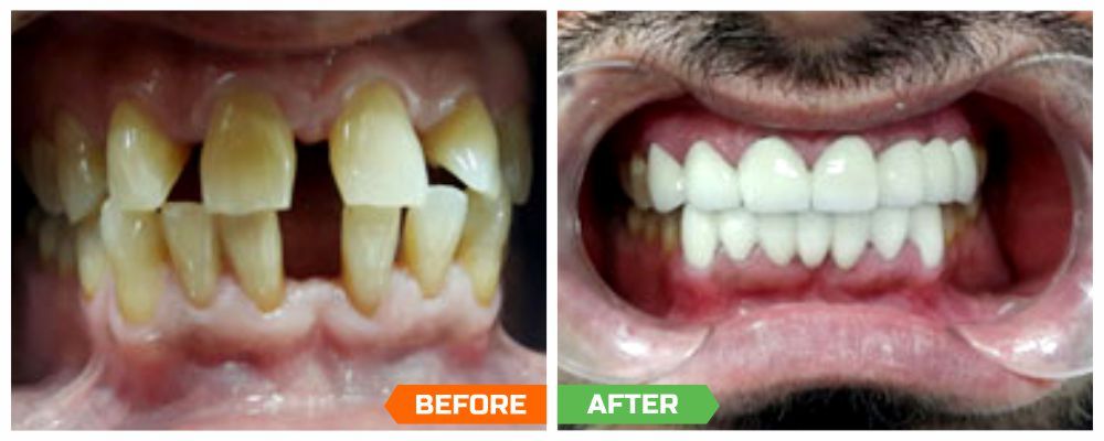 Top dental implant surgeons in India
