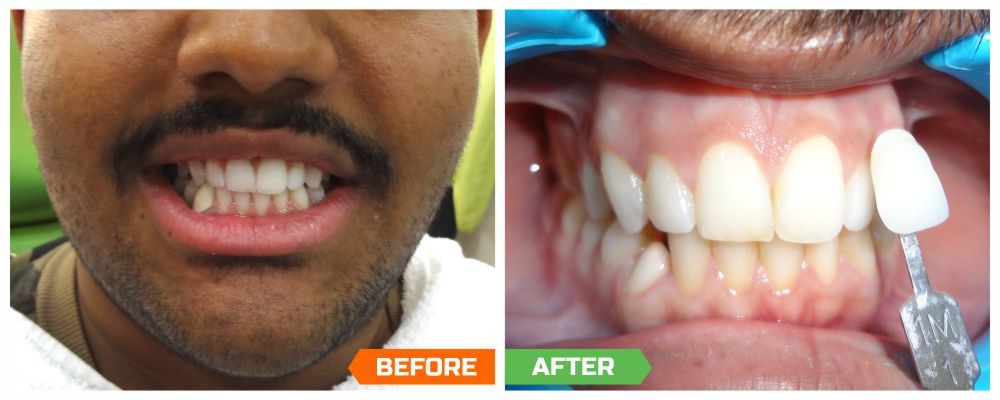Dental Implant cost in India