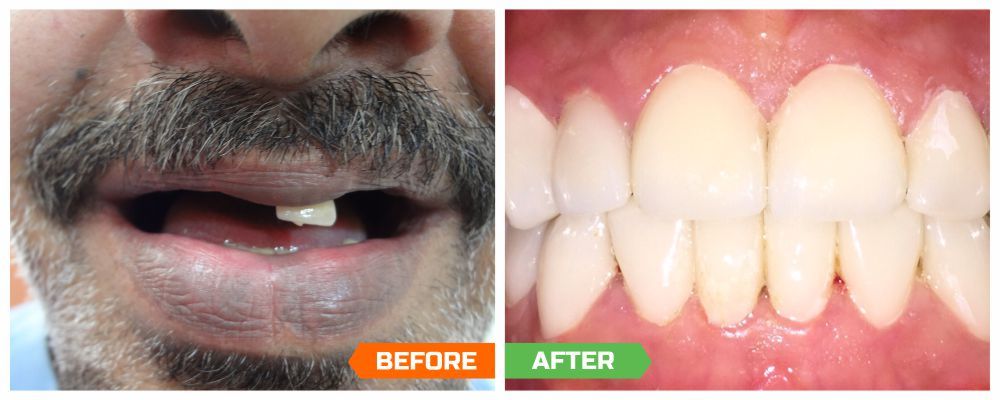  Affordable Dental Implant Clinics in India