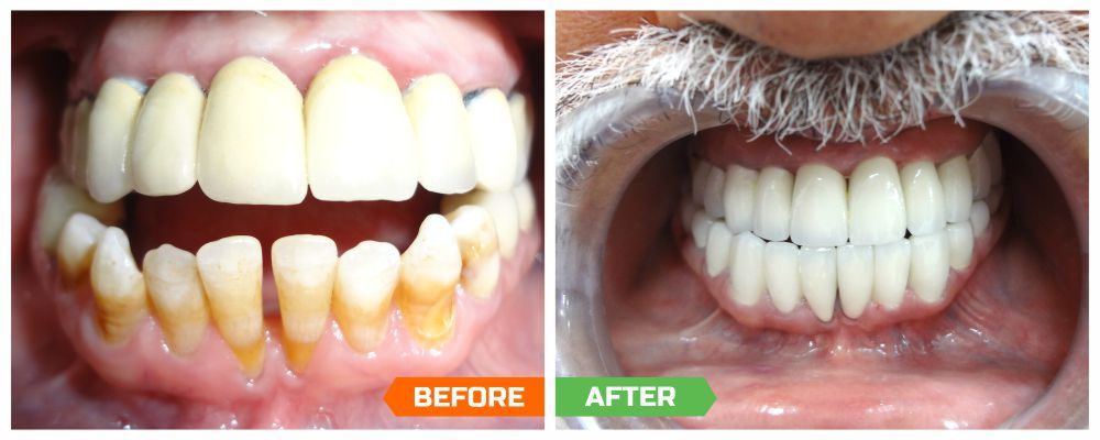 Low Cost Dental Implant in India