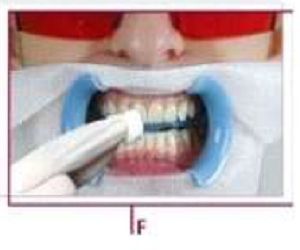 teeth whitening cost
