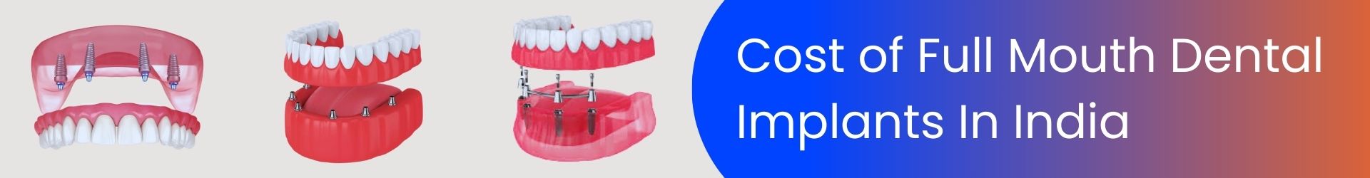 Price-of-full-mouth-dental-implants-in-India