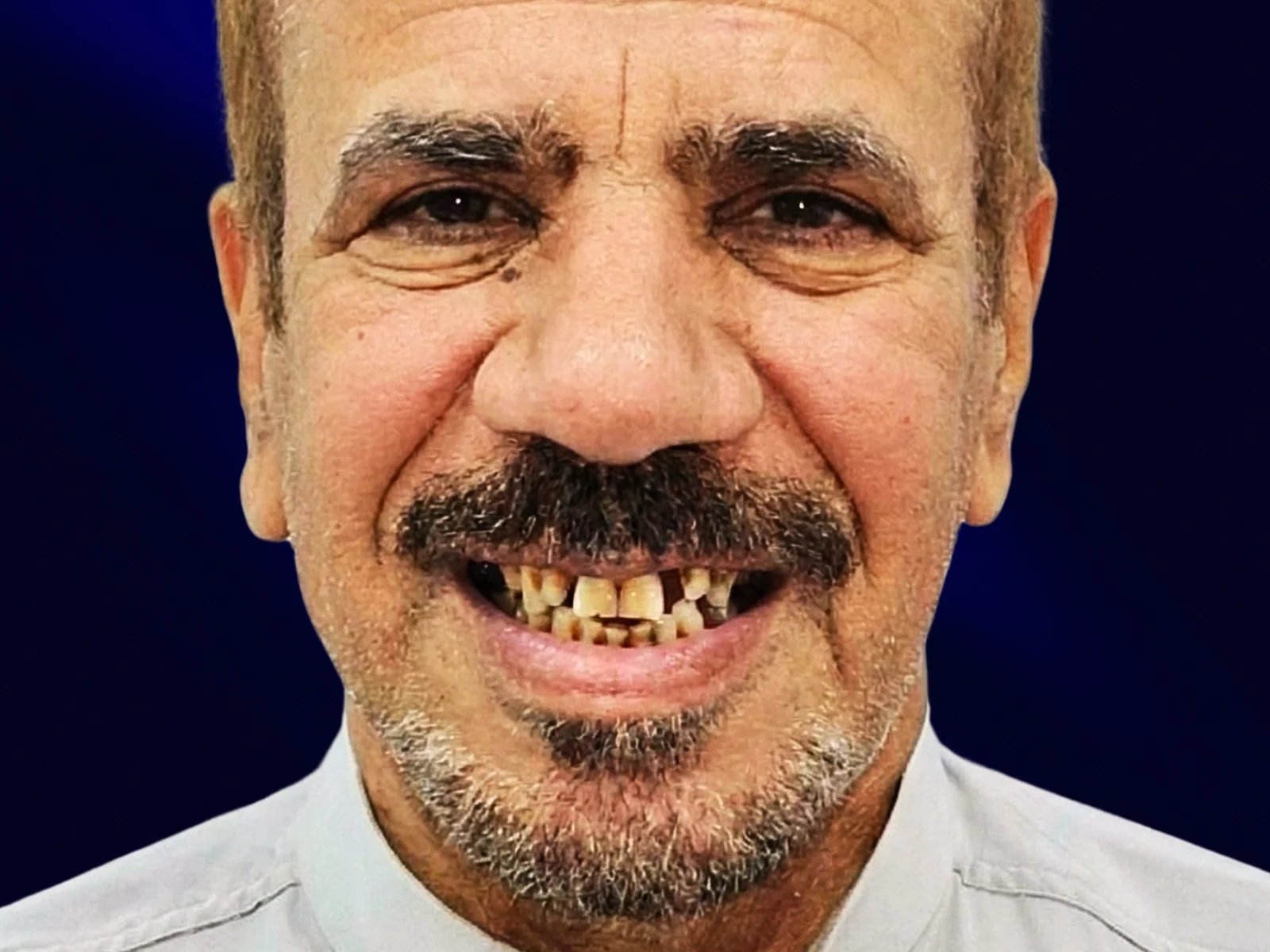 Smile makeover and dental veneers — beautiful result at HaiDent Mumbai before