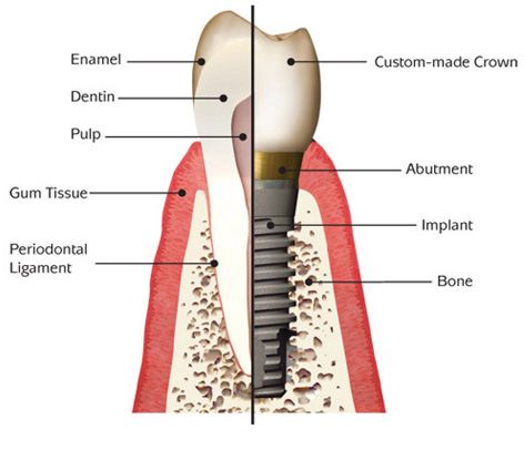 Best Dental Implant Clinic in Mumbai