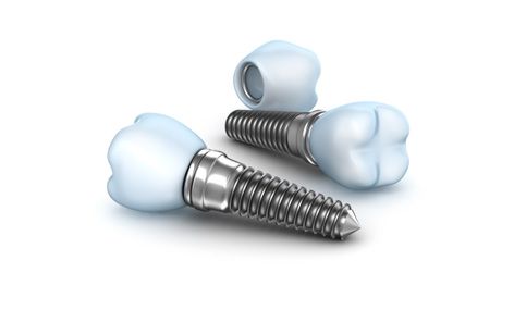 Best dental implant hospitals in India