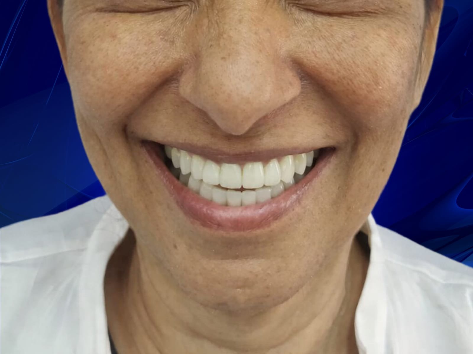 After full mouth All-on-6 dental implants at HaiDent — Zirconia prosthetics result case 5