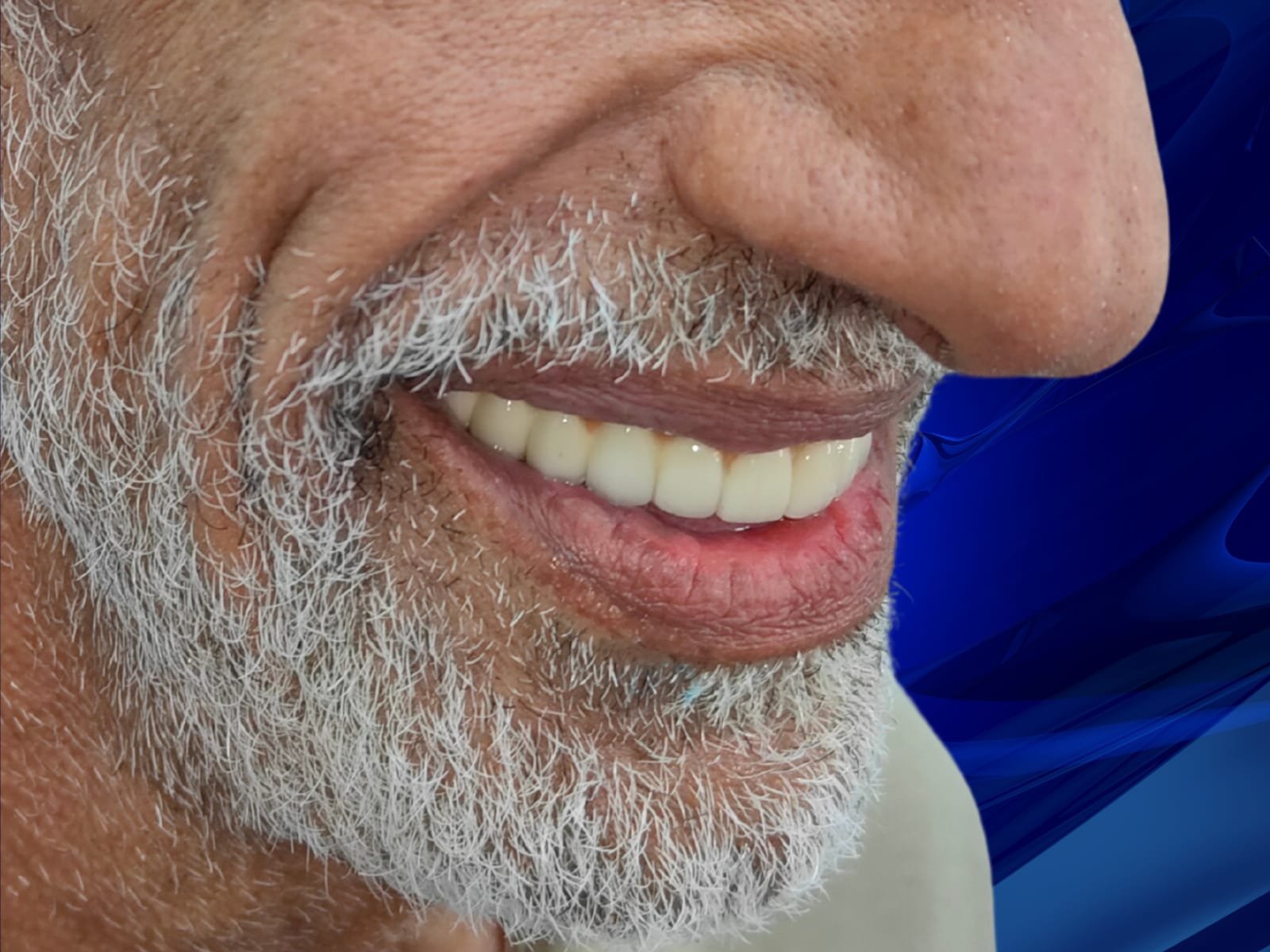 After dental implant treatment at HaiDent Gurgaon — patient smile restoration case 6