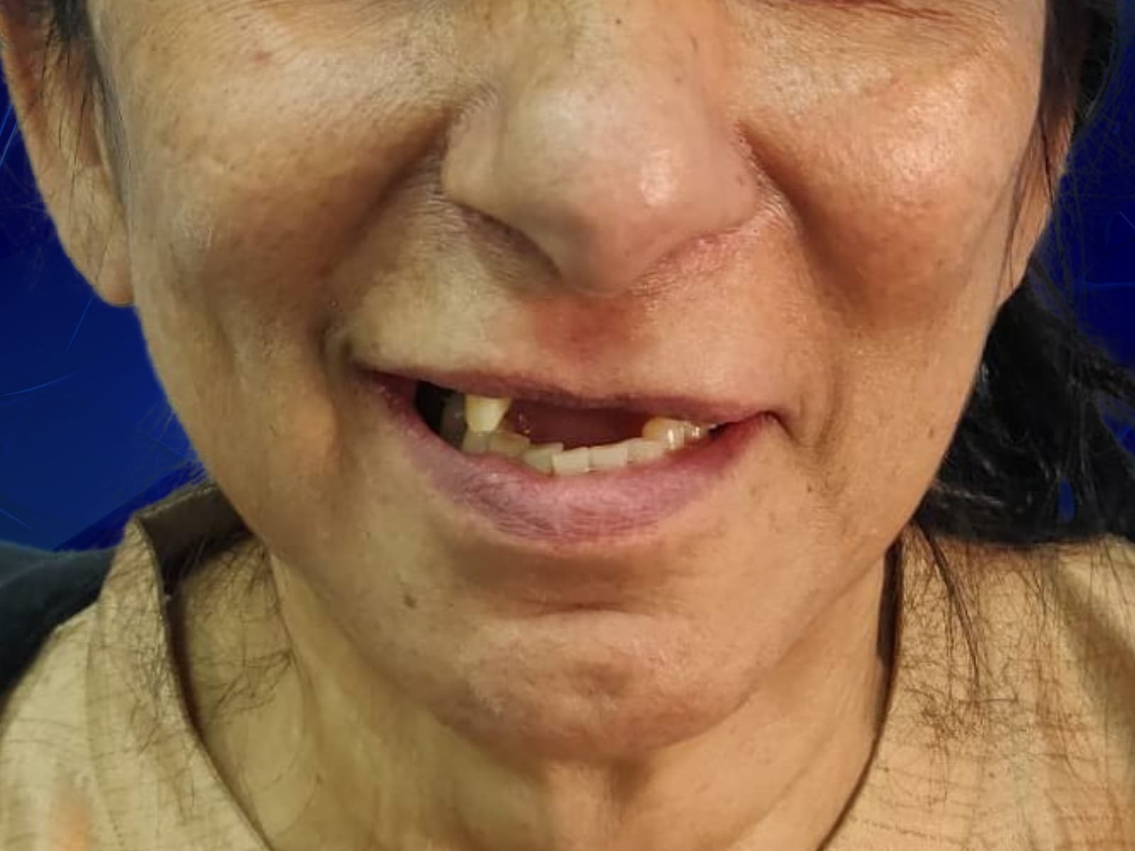 Before full mouth dental implant treatment at HaiDent — multiple missing teeth case 5