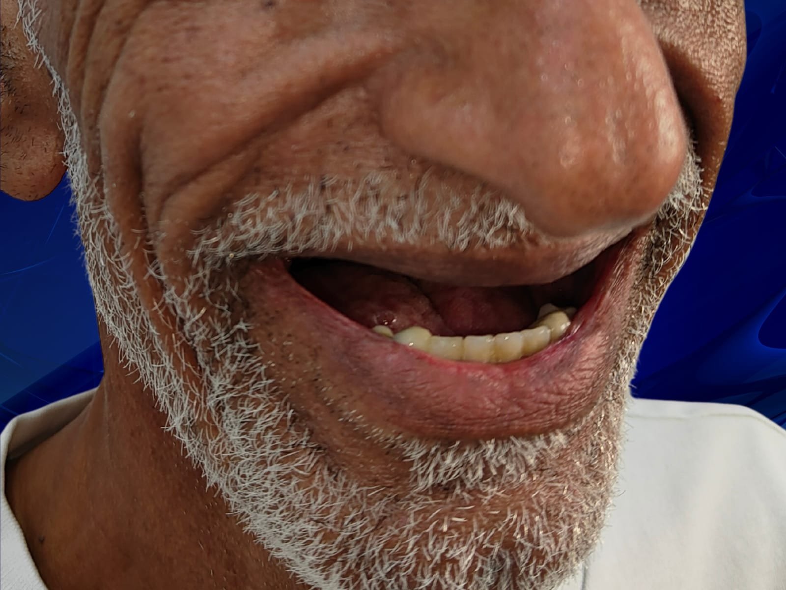 Before dental implant treatment at HaiDent Gurgaon — patient with missing teeth case 6