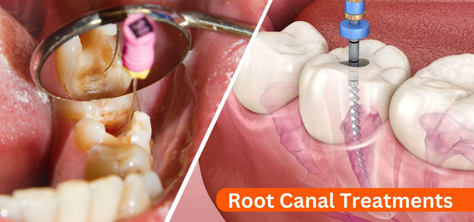 root canal treatment price in mumbai